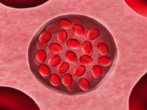 Know about the sickle cell anemia, an inherited blood disorder