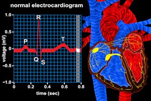Track ventricle depolarization via the QRS complex in an electrocardiogram to observe electrical conduction